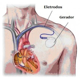 Gerador de Marcapasso Implantável Camara Única