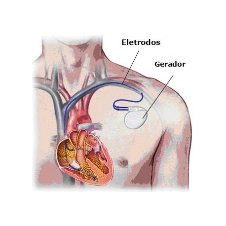 Gerador de Marcapasso Implantável Camara Única