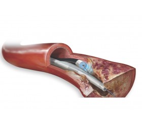 Cateter Guia a Laser com  Aterectomia a Laser Turbo-Tandem