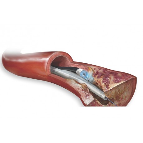 Cateter Guia a Laser com Cateter de Aterectomia a Laser Turbo-Tandem